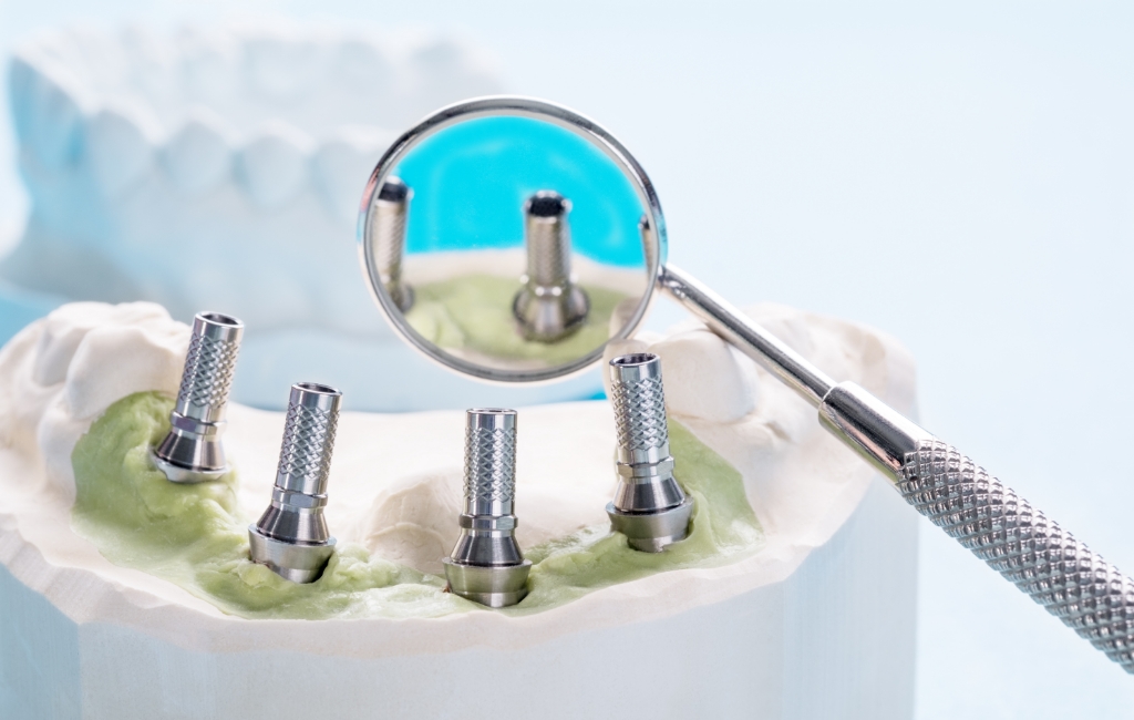 All-on-4 With Bone Loss: Is Bone Grafting Really Necessary?